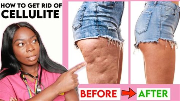 Best cellulite cream - How To Discuss