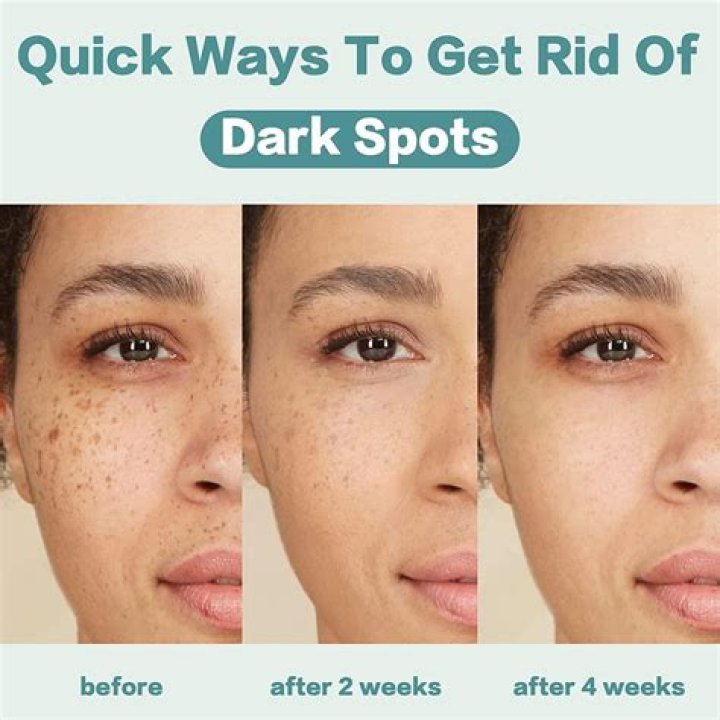 Best dark spot remover - How To Discuss