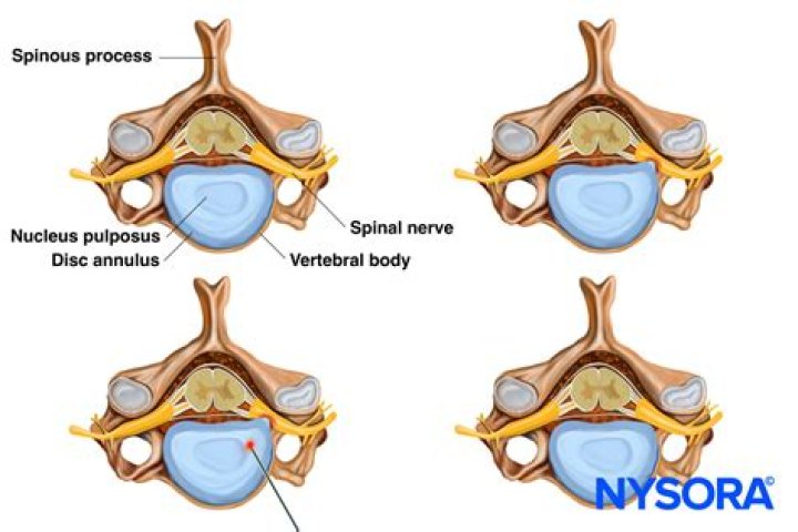Bilateral Foraminal Stenosis - How To Discuss