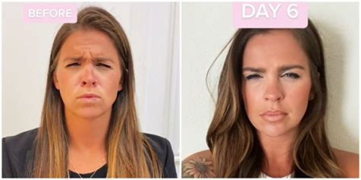 Botox day 7 vs day 14