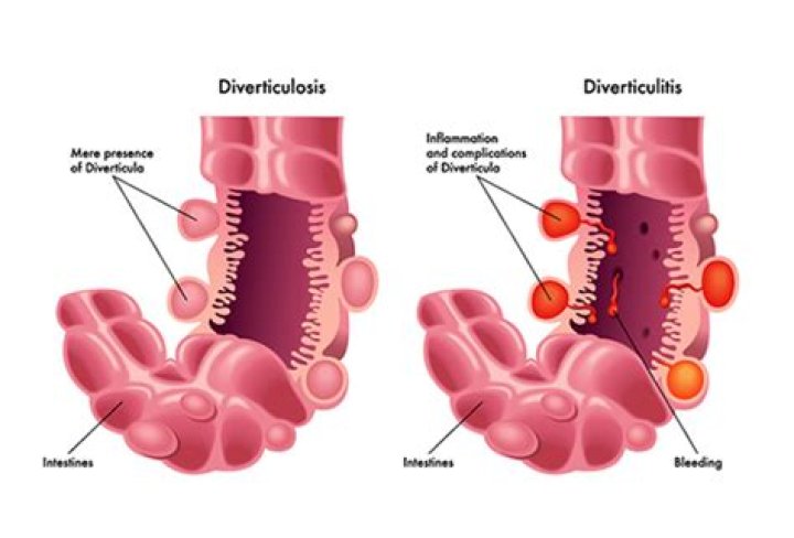 Can diverticulitis cause nausea