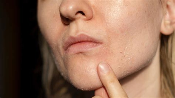 Can dry skin cause acne