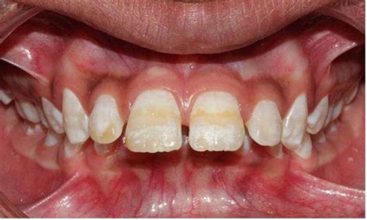 Can fluorosis be cured