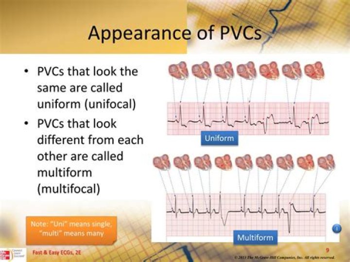 Can you hear PVCs with stethoscope