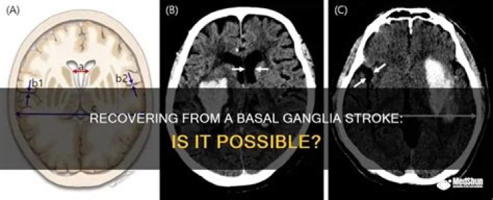 Can you recover from a basal ganglia stroke