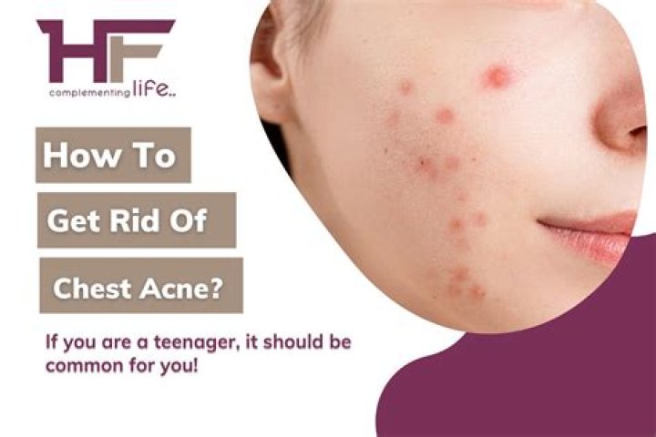 Chest acne - How To Discuss