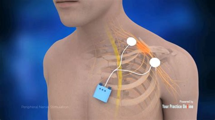 Chest Electrical Muscle Stimulation - How To Discuss