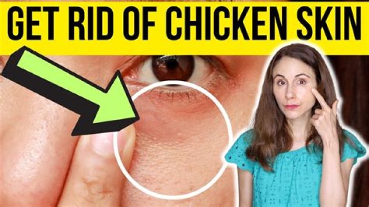 Chicken skin treatment - How To Discuss