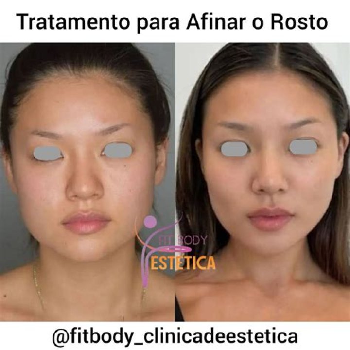 Como Afinar O Nariz Com Pregador