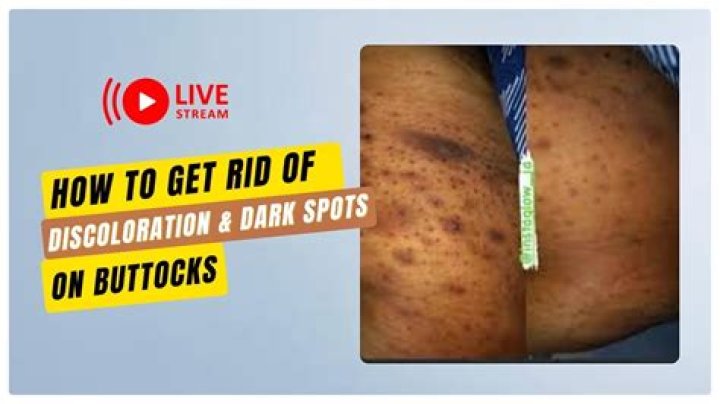 Dark spots on buttocks - How To Discuss