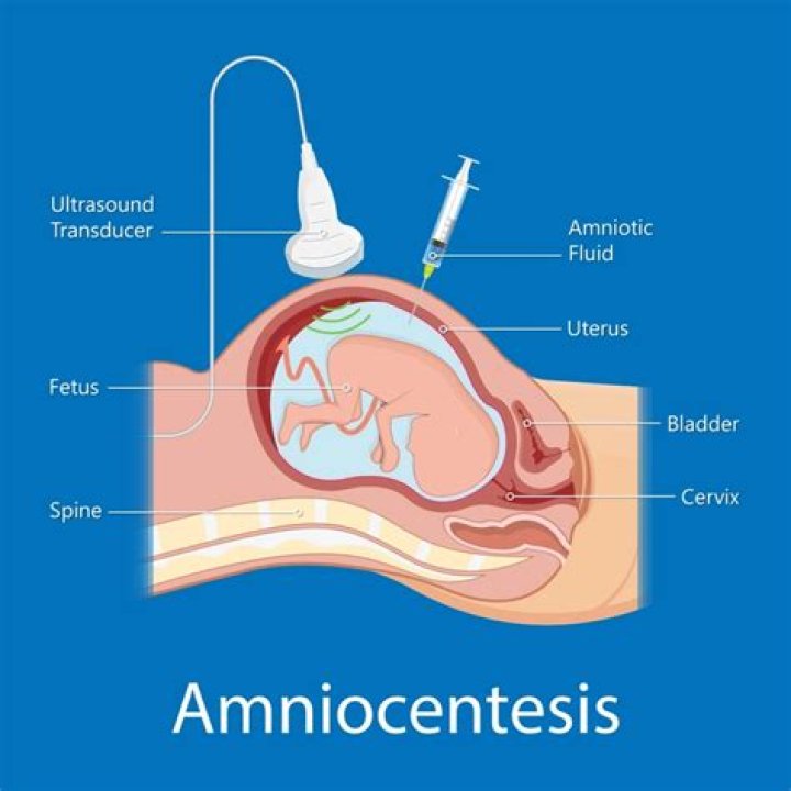 Do they numb you for an amniocentesis