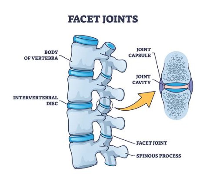 Does facet joint pain go away