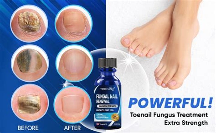 Does gentian violet work on toenail fungus
