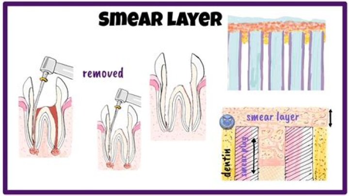 Does Self Etch remove smear layer