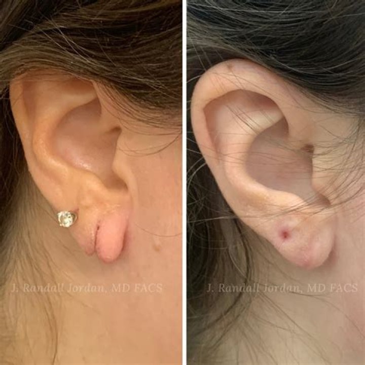 Ears Hurt After Not Wearing Earrings For A While