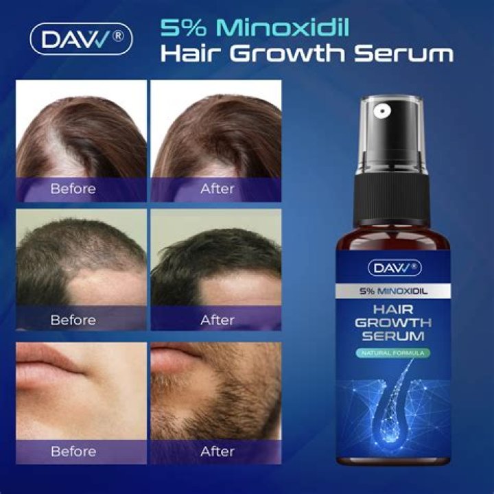 Gzbityhn Hair Growth Essence How To Use