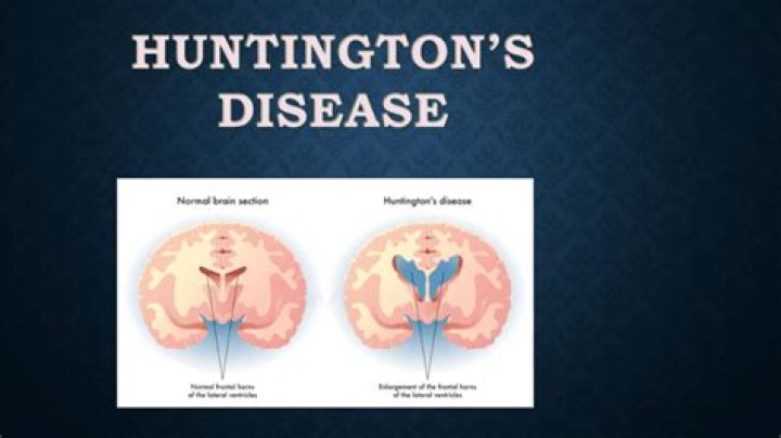 How common is Huntingtons disease in Australia