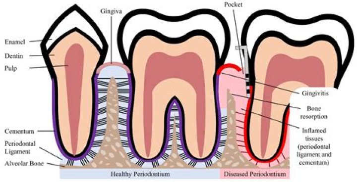 How do they test for periodontal disease