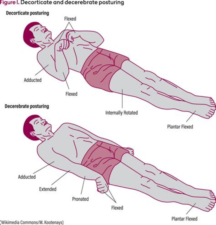 How do you abolish Decerebrate rigidity