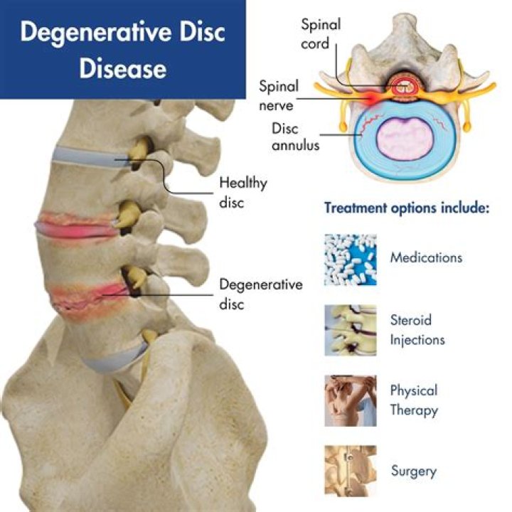 How do you code degenerative disc disease