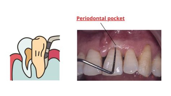 How do you fix periodontal pockets