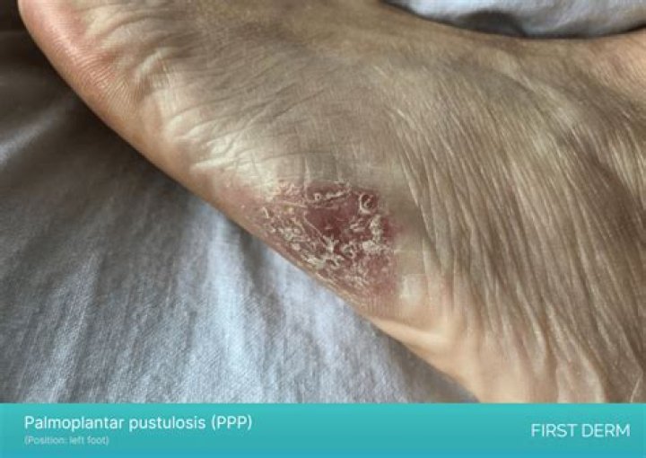 How do you get rid of Palmoplantar Pustulosis