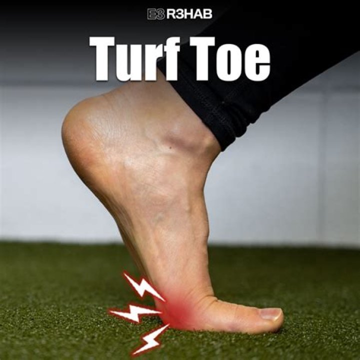 How do you know if you have turf toe