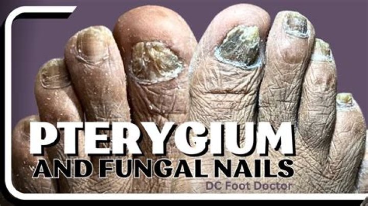 How do you treat pterygium nails