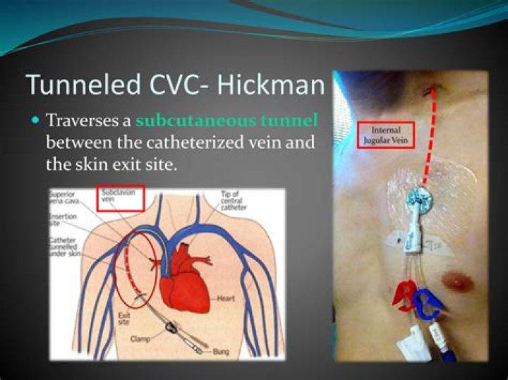 How is a Groshong catheter inserted
