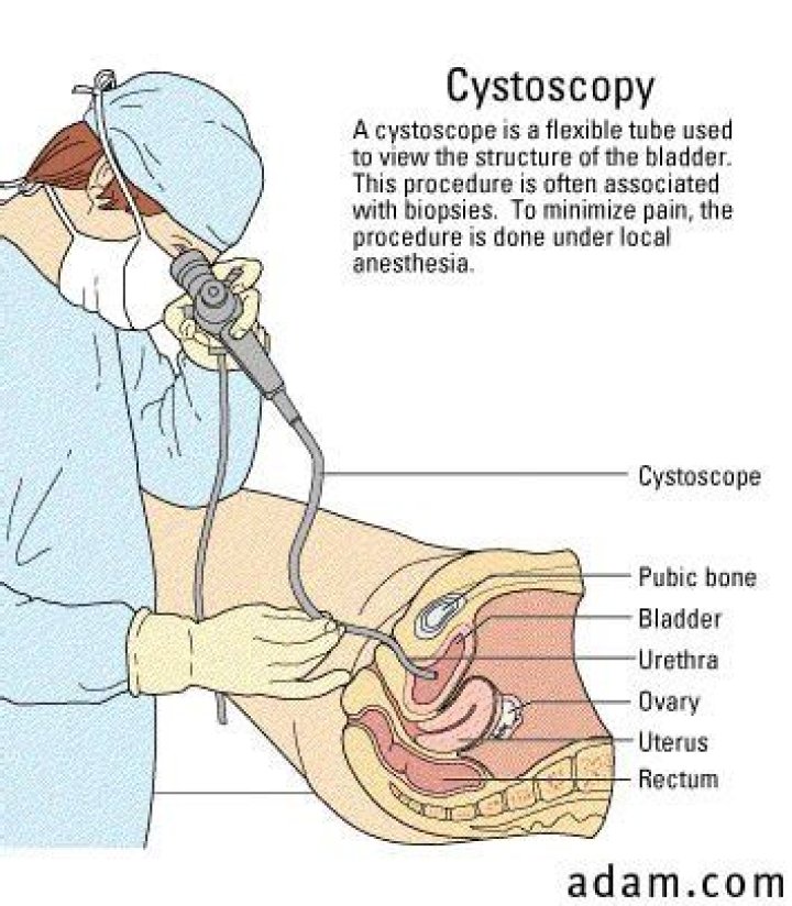 How Long Does A Cystoscopy Take