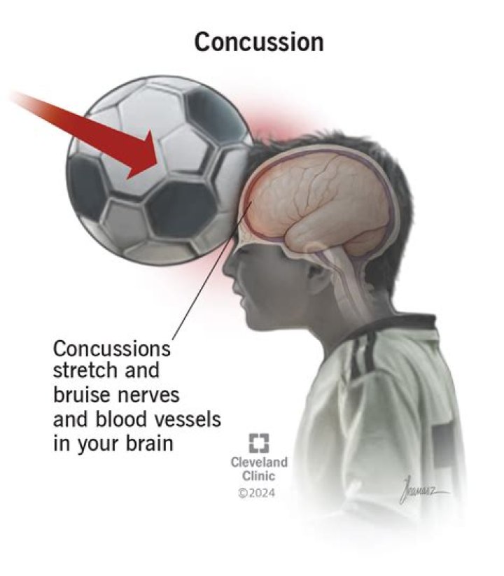 How Much Force Is Needed To Cause A Concussion