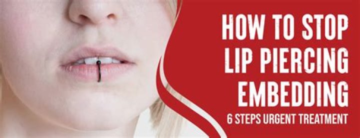 How To Stop Lip Piercing Embedding