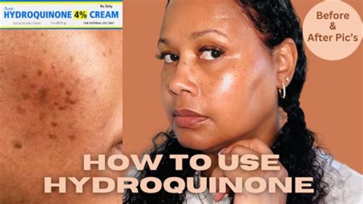 Hydroquinone products - How To Discuss
