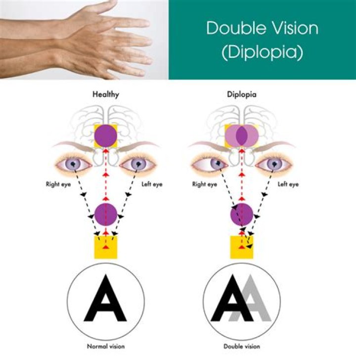 Is Double Vision Haplopia or diplopia