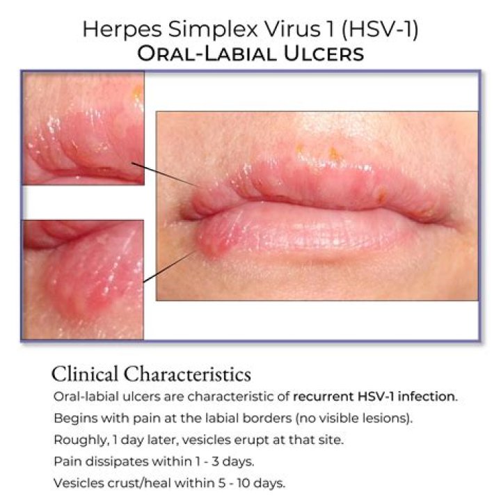 Is herpes a medical condition