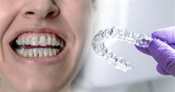 Is Invisalign Tax Deductible - How To Discuss