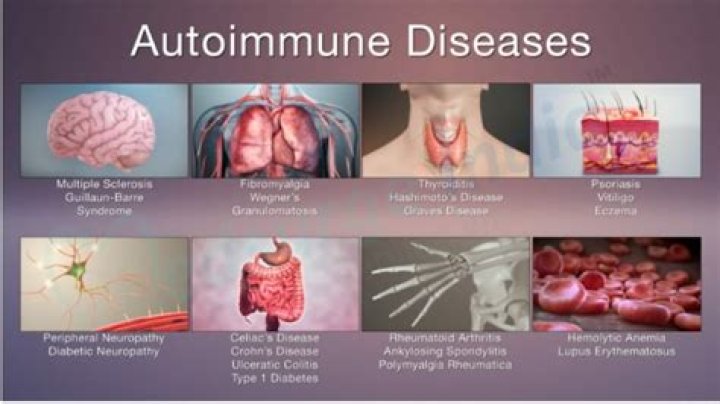 Is osteoarthritis a autoimmune disease