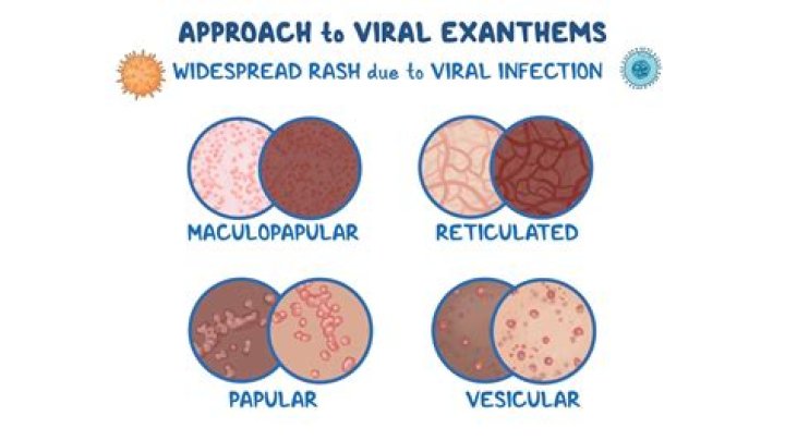 Is viral Exanthem rash contagious