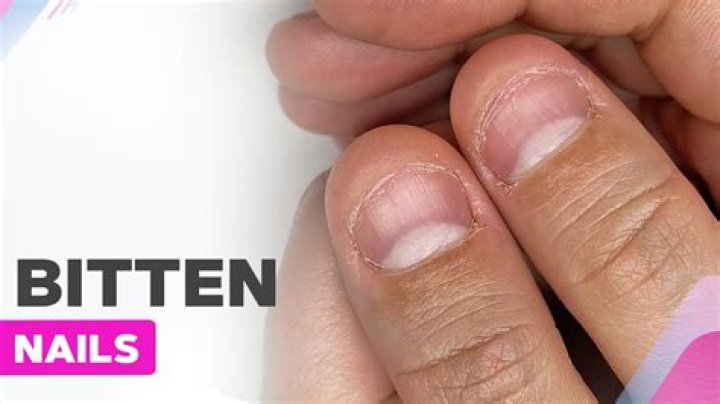 Question: How To Heal Nails After Biting