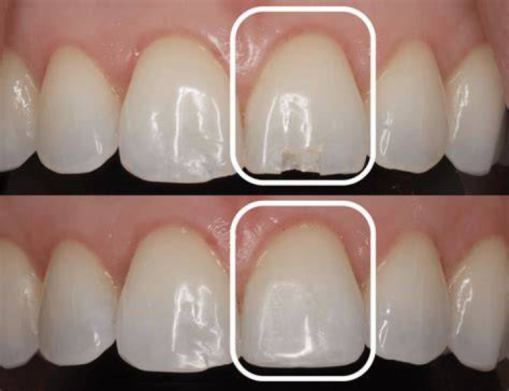 Quick Answer: How To Repair Chipped Enamel Jewelry