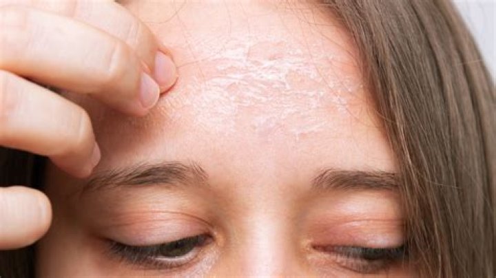 Scaly skin on face - How To Discuss