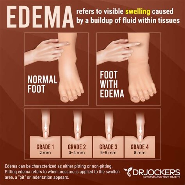 The Suffix Edema Means - How To Discuss