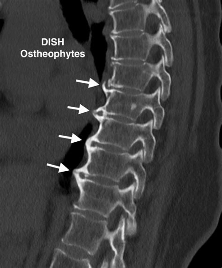 What are flowing osteophytes