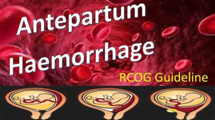 What are the causes of antepartum haemorrhage