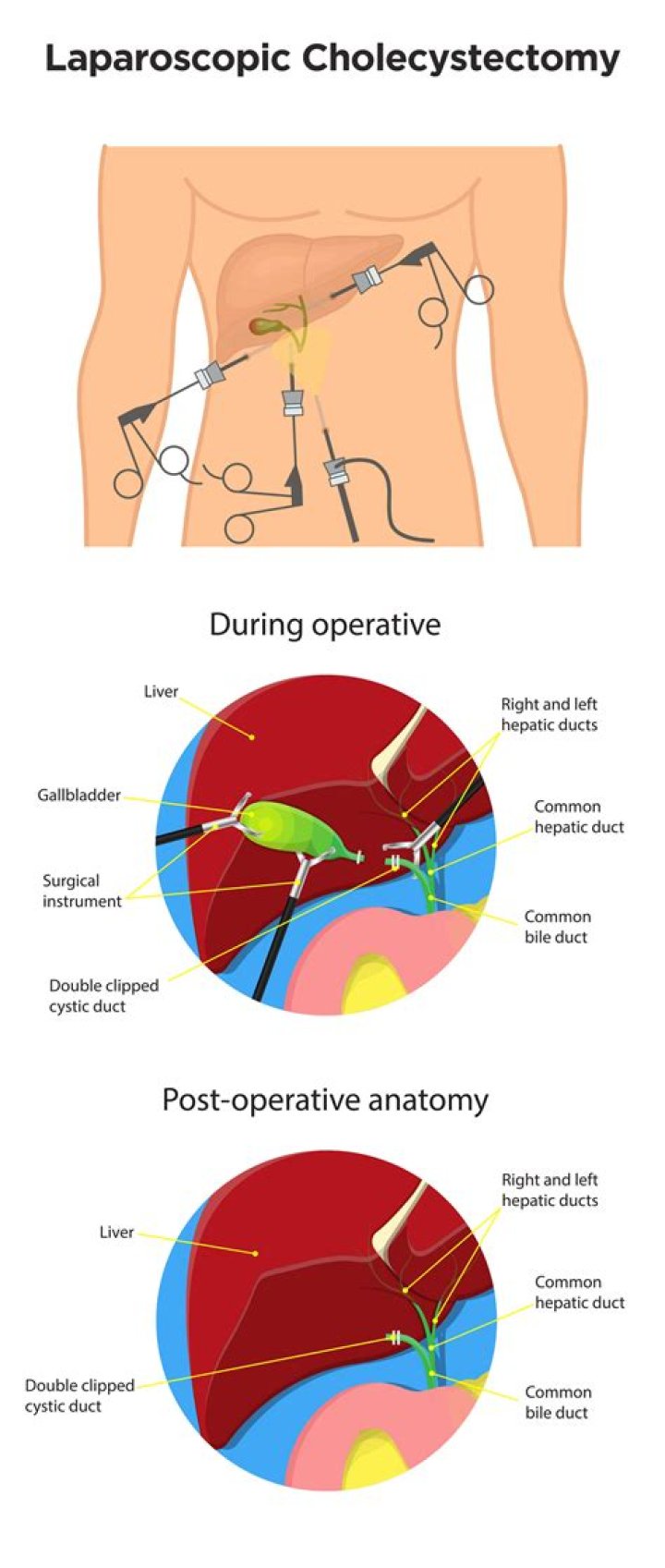 What are the complications of laparoscopic cholecystectomy