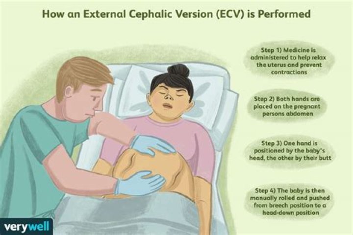 What does ECV mean in medical terms