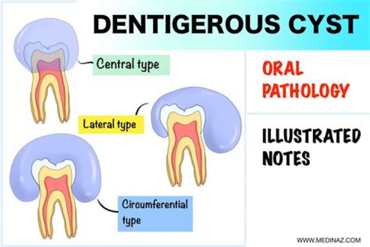 What is a Dentigerous cyst