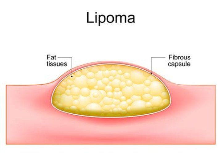 What is a fatty tumor called