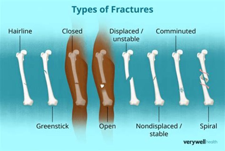 What is a Grade 3 fracture
