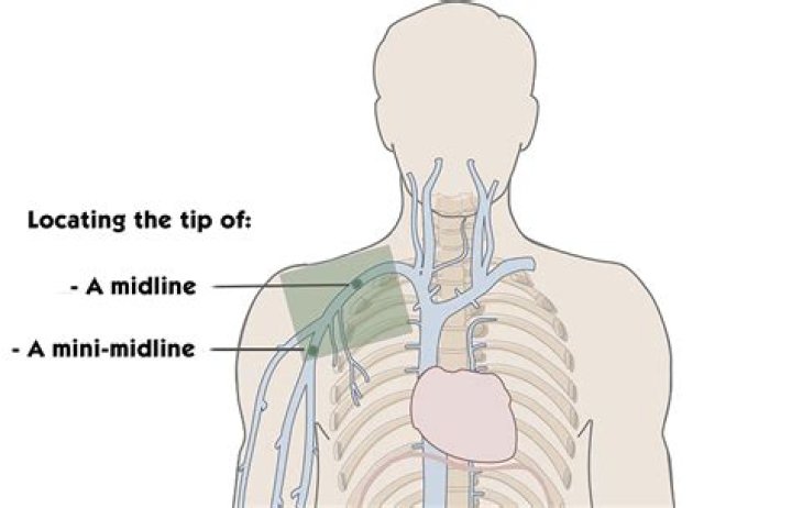What is a midline procedure